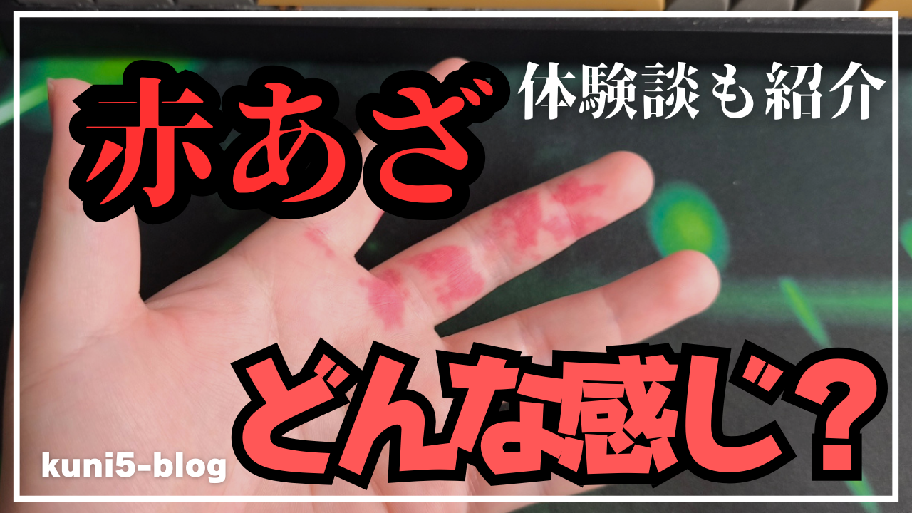 【生まれつき赤痣】痛い感覚？熱い感覚？などの質問への最適解と気まずくならない初対面での向き合い方