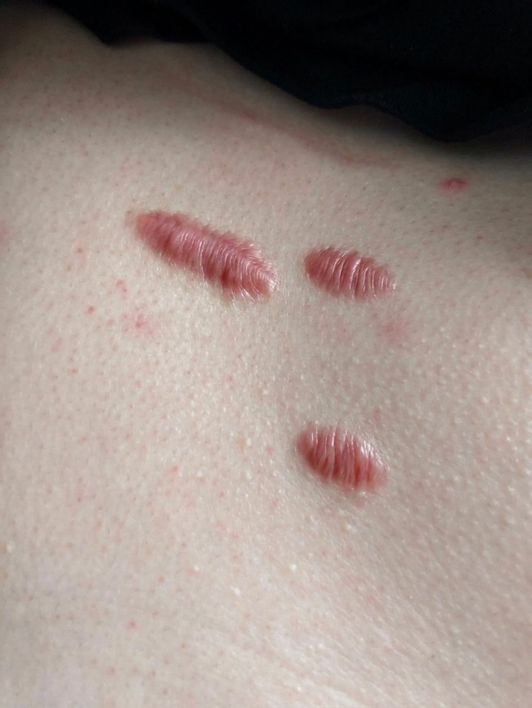 【ケロイド治療】ステロイド注射の効果！治し方・痛み・費用と期間